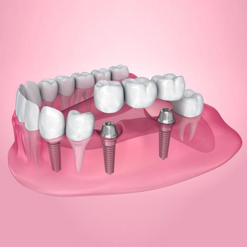 Dental-Crown